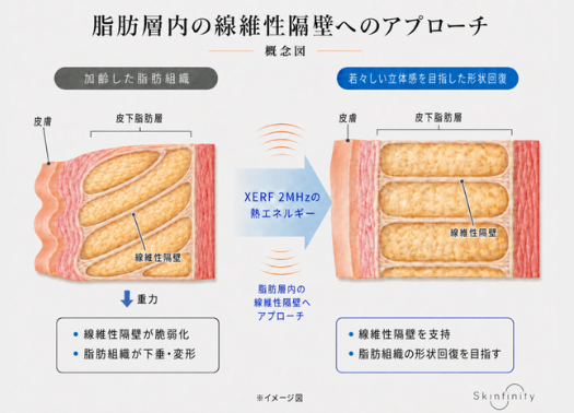 脂肪層内の線維性隔壁へのアプローチ